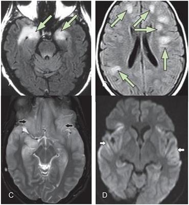 Systematic Review: Syndromes, Early Diagnosis, and Treatment in Autoimmune Encephalitis